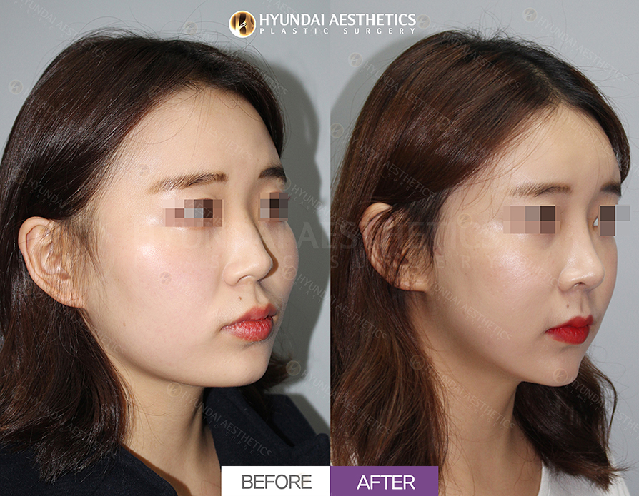Low-Nose Surgery + Alar Base Reduction