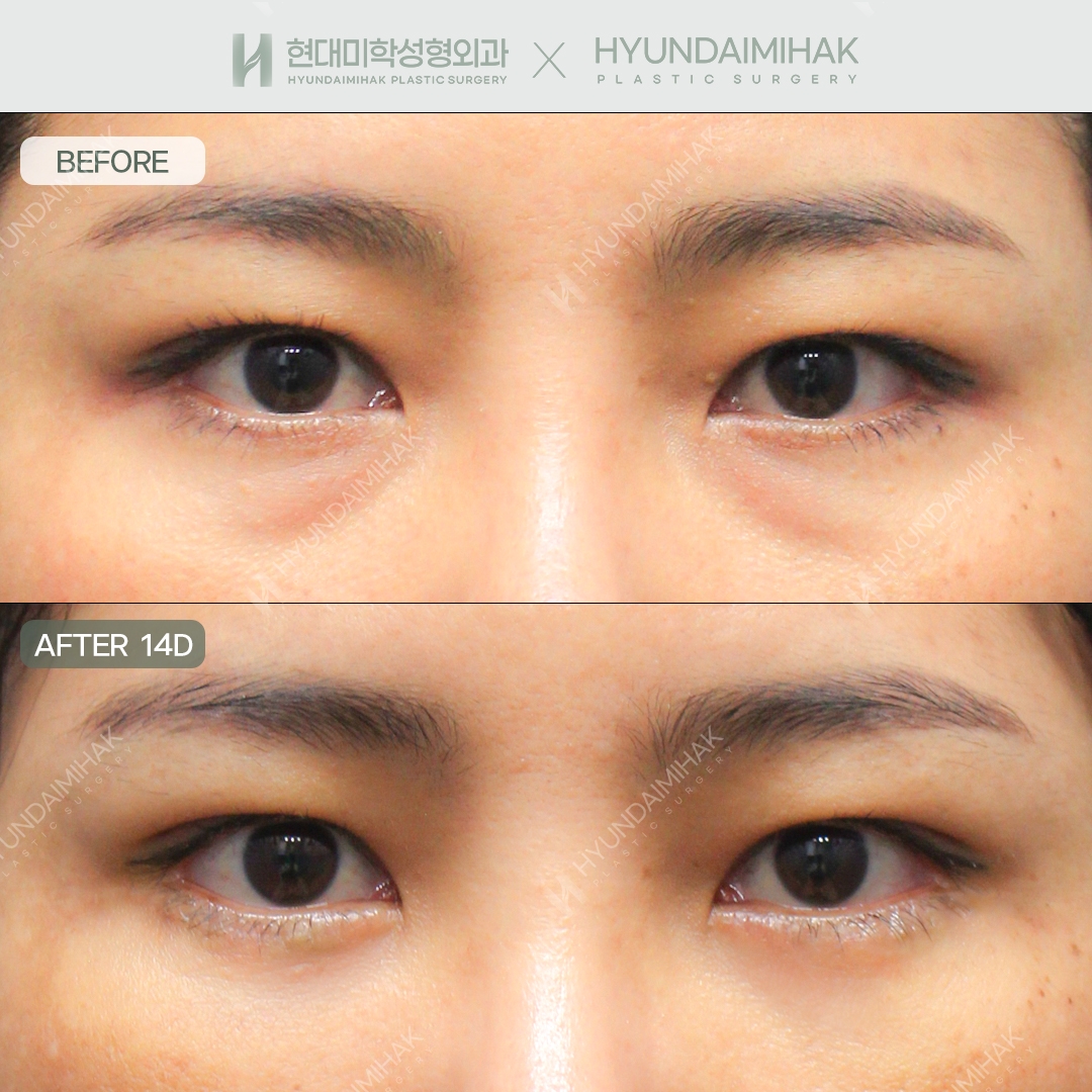 [Anti-Aging Surgery] Under-Eye Fat Repositioning