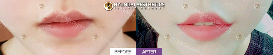 Mouth Corner Lift + Marionette Lines