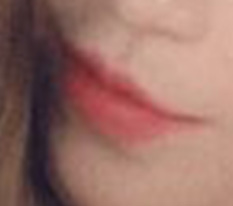 After mouth-corner surgery, I hear so often that my impression improved a lot :)