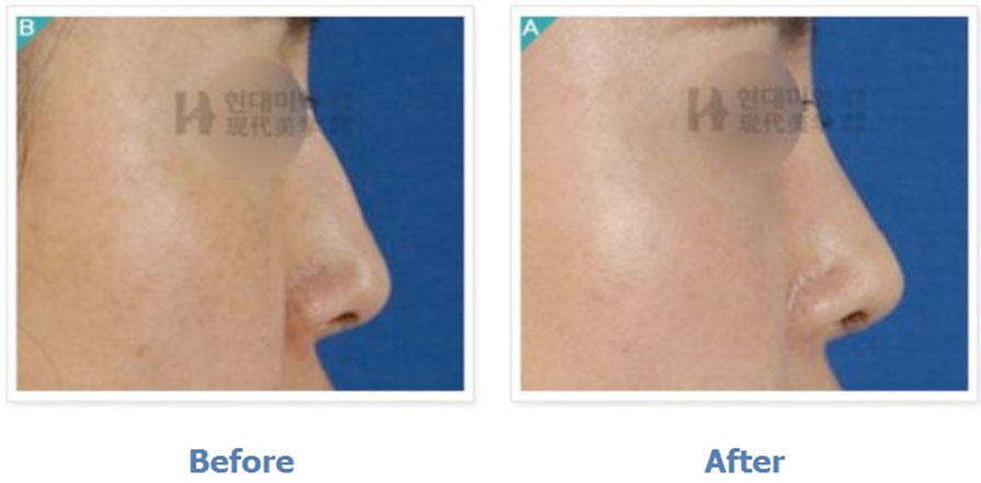 Scalp-fascia rhinoplasty