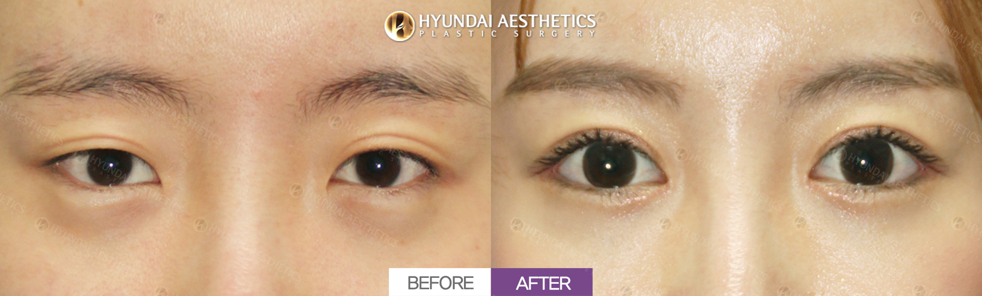 Incisional ptosis correction + double eyelid surgery + epicanthoplasty + lateral canthoplasty + lower canthoplasty, 1 month