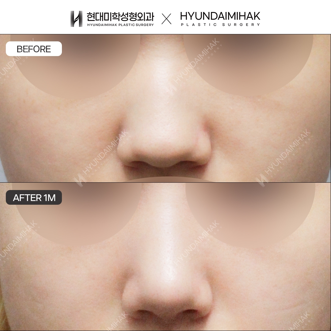 [Low Nose Surgery] Bridge + Tip, 1 Month