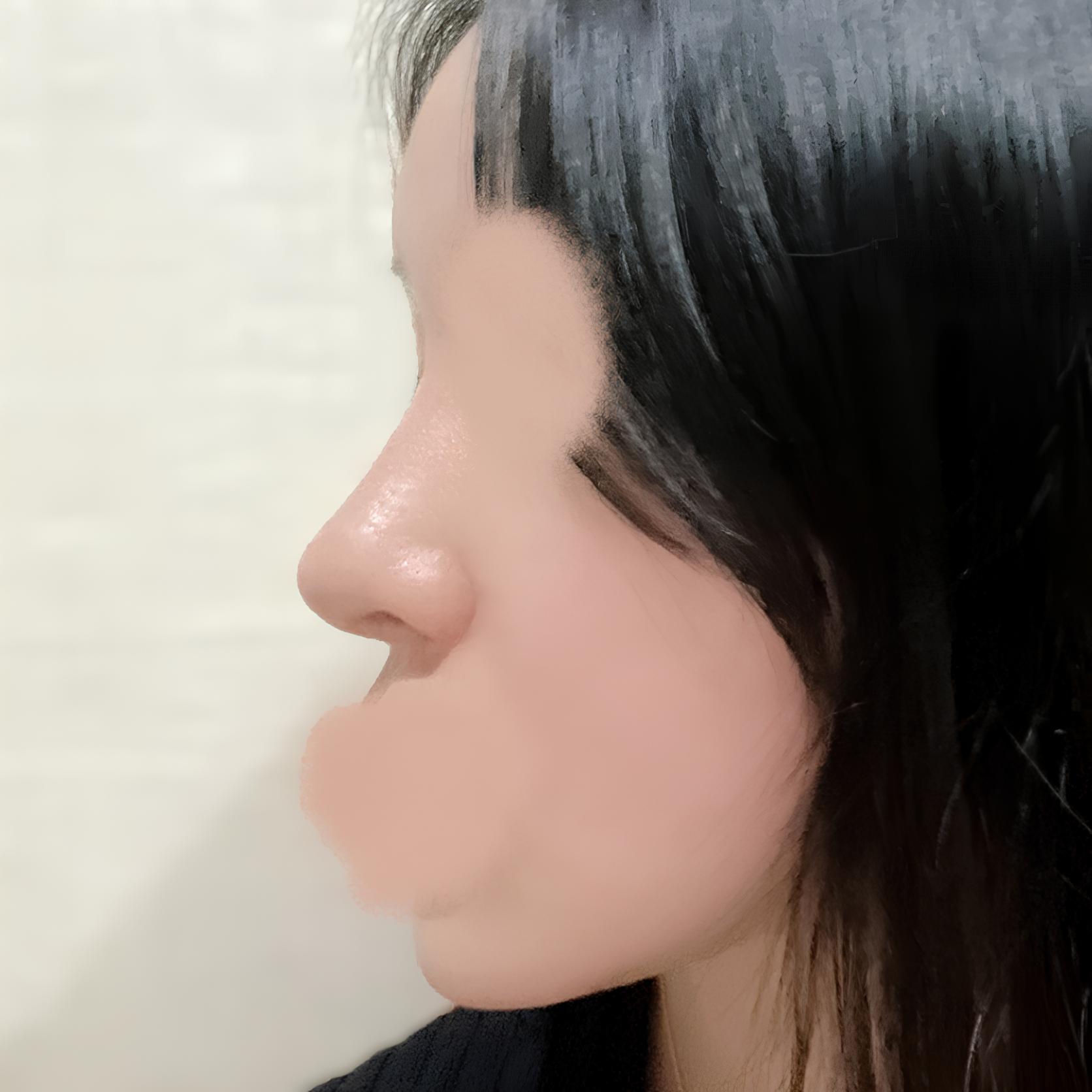 From a bulbous nose to a slim straight-slope nose