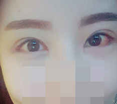 Revision eye surgery + back + lower + front canthoplasty review+_+