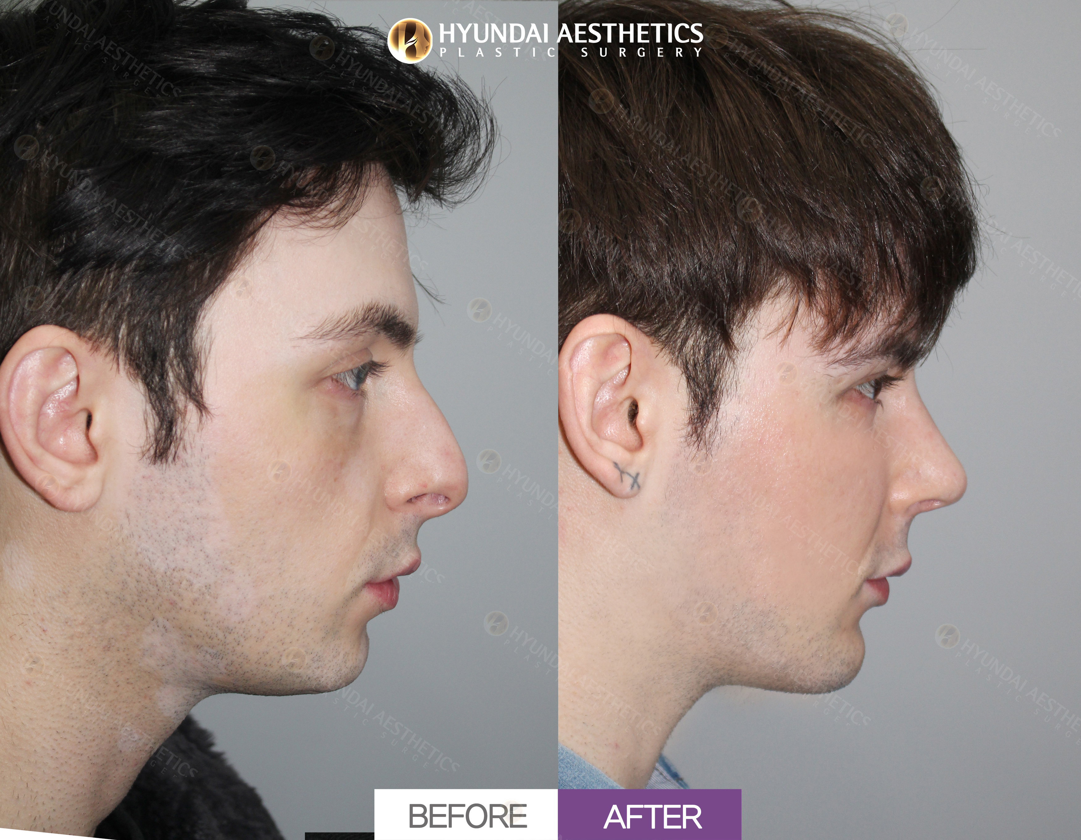 Nasal Bridge, Nasal Tip, and Nostril Reduction, 1 Month