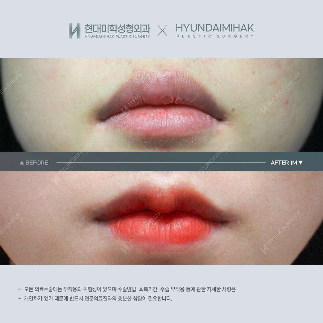 [Lip Surgery] Cupid's Bow Lip Surgery, 1 Month