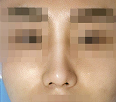 Review 2 months after male rhinoplasty.