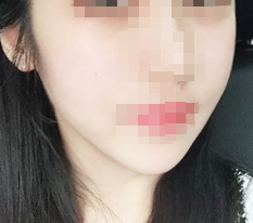 Chin tip reduction!! Review~