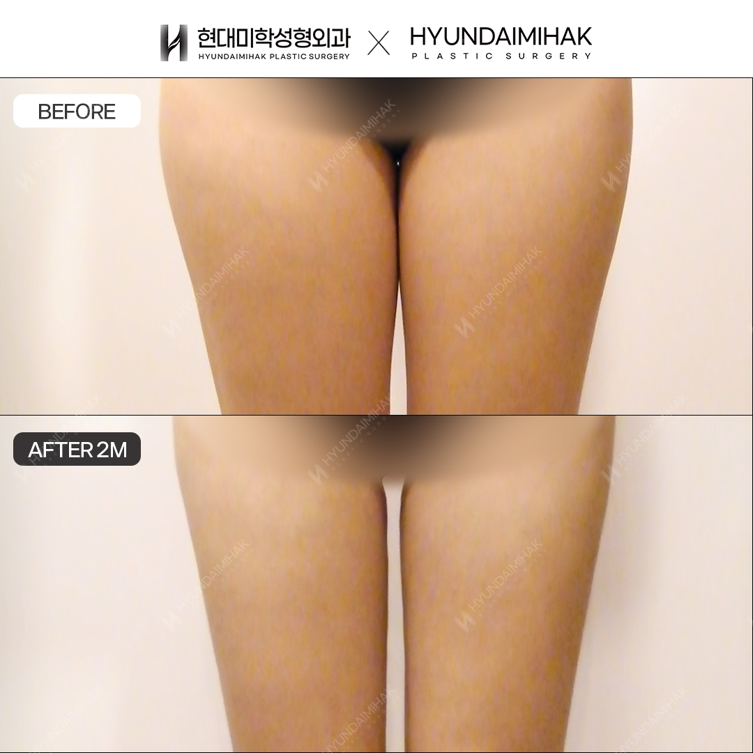 2 months after thigh liposuction