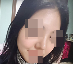 Hyundai Aesthetic Surgery made my short, chubby bulbous nose pretty^_^