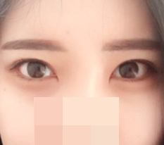 It's all thanks to dual epicanthoplasty