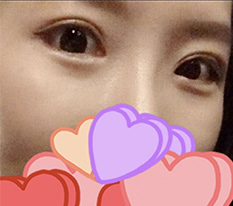 I am finally posting my revision eye surgery review^^
