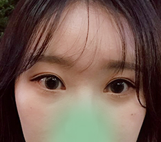 Successful image change with ptosis correction and canthoplasty :)