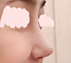 Changes after revision rhinoplasty