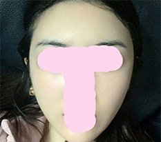 It's been one month since my cheekbone surgery ^^