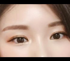 Leaving a review of my eye surgery^^