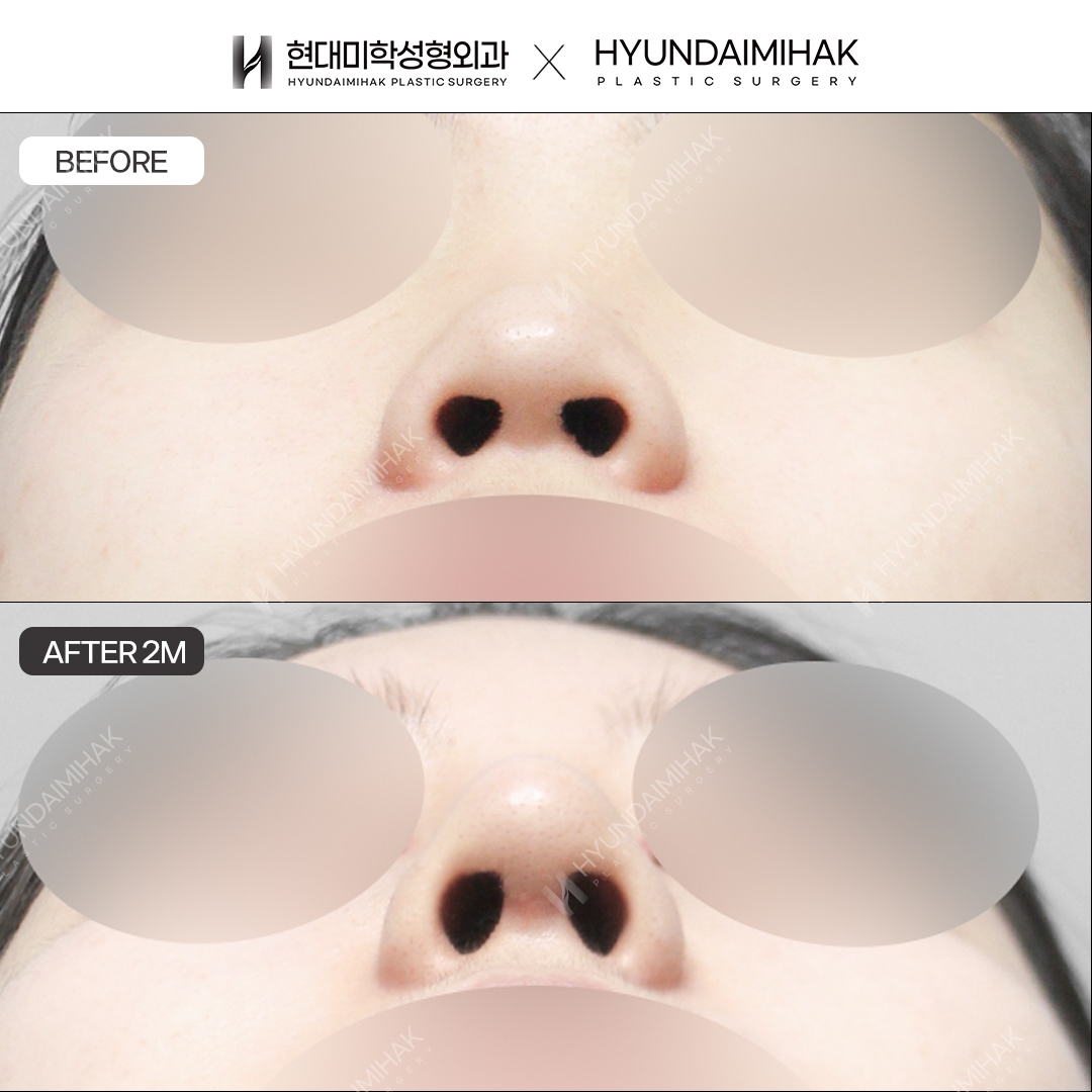 [Low nose rhinoplasty] Nasal bridge + nasal tip, 2 months post-op
