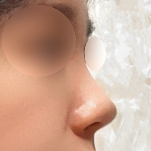 Nose surgery review!