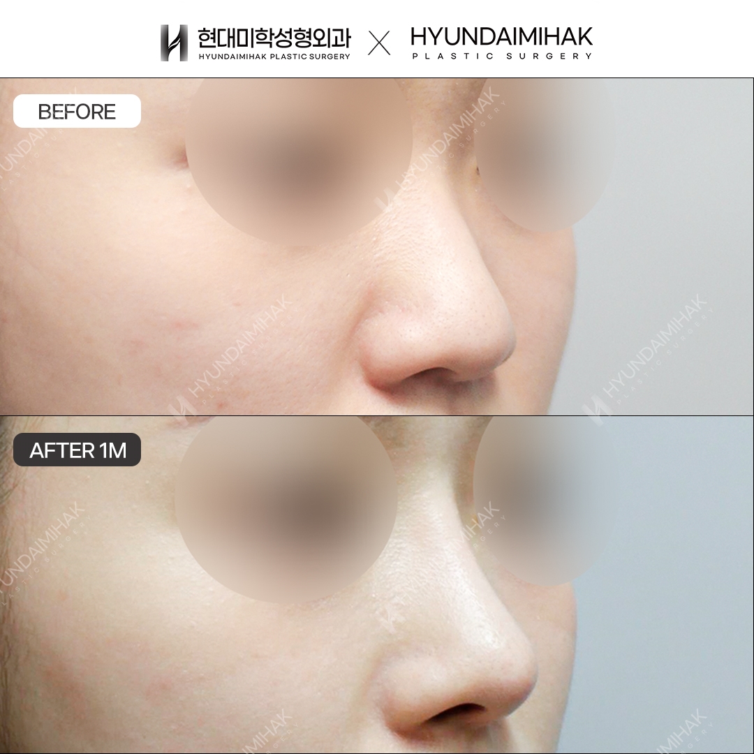 [Bulbous Nose Surgery] Nasal bridge + nasal tip, 1 month post-op