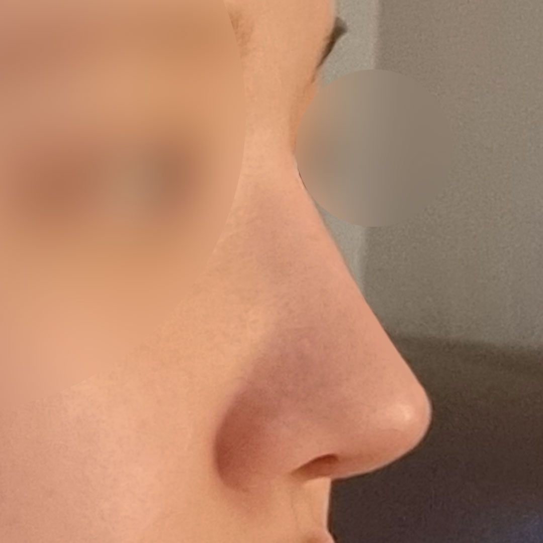 Review after fixing the ugly nose I had for 25 years