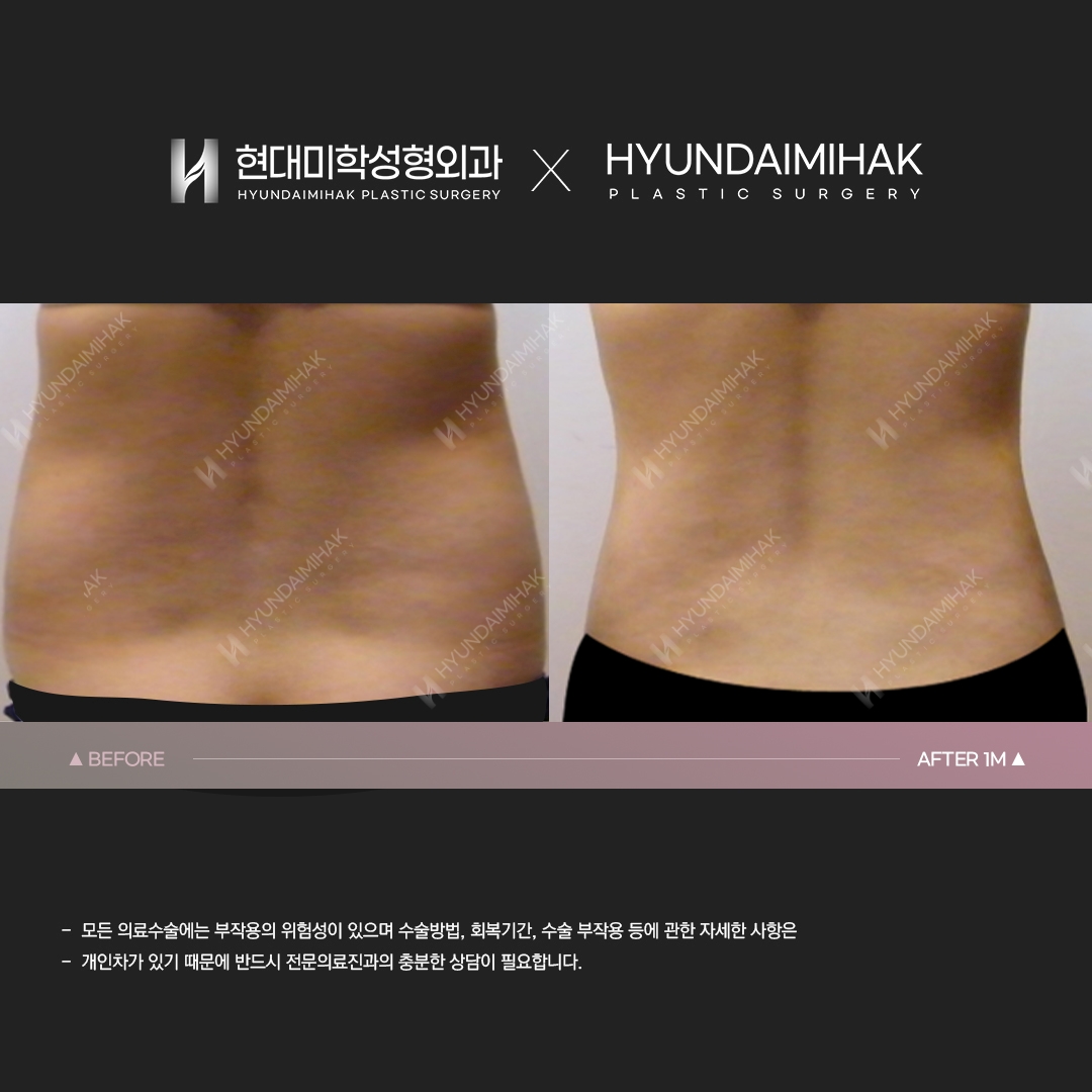 Abdominal liposuction, 1 month post-op