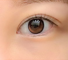 Looking younger after eye revision~~