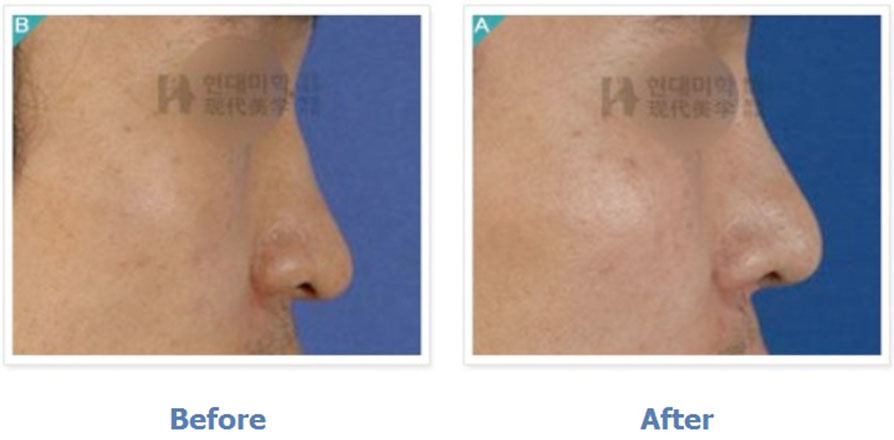Rib-cartilage rhinoplasty