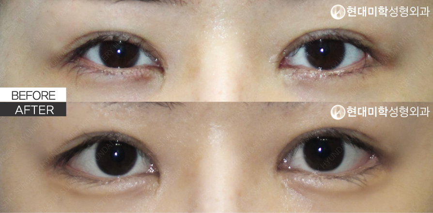 Non-Incision Under-Eye Aegyo + Dual Canthoplasty (Revision Surgery)