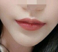 The long-awaited 6-month corner lip lift review ㅜㅜㅜㅜㅜㅜ