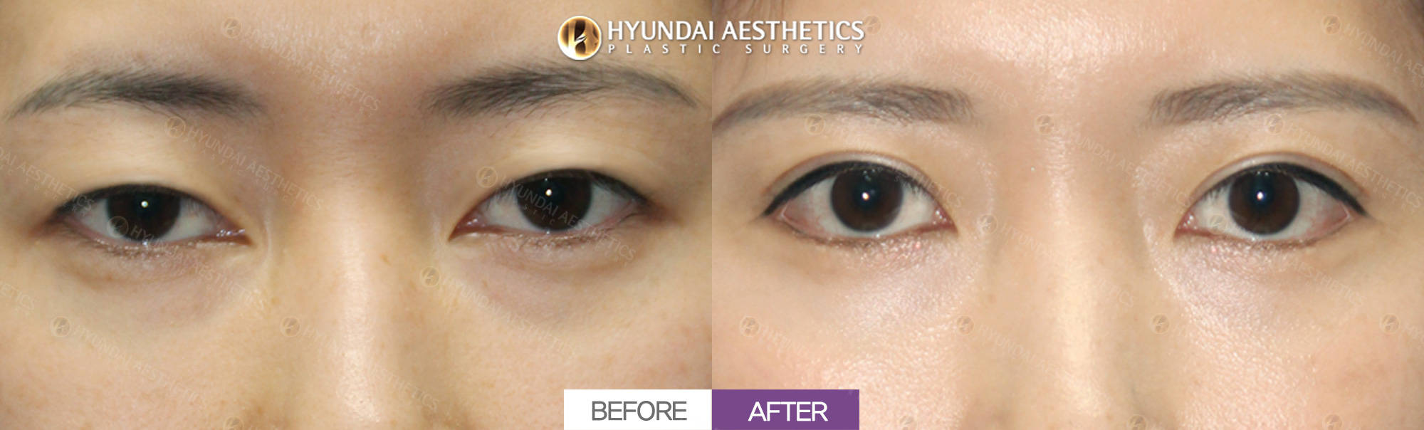 Revision eye surgery (epicanthoplasty reversal, incisional ptosis correction, double eyelid surgery), 1 month