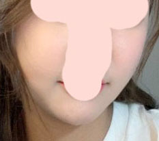 Real review 2 months after cheekbone surgery~