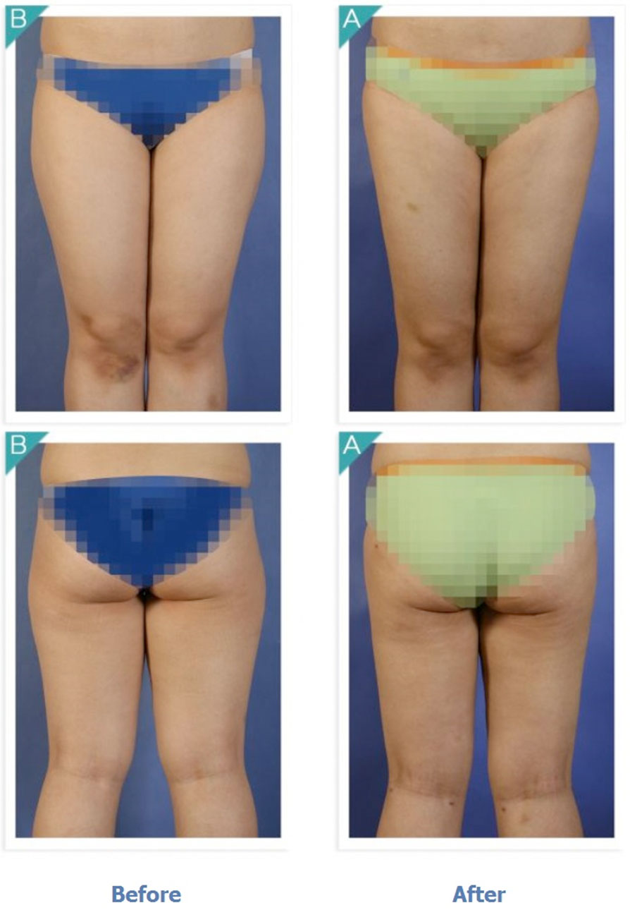 Body Contouring / Thigh Liposuction