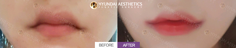 Mouth Corner Lift + Cupid's Bow
