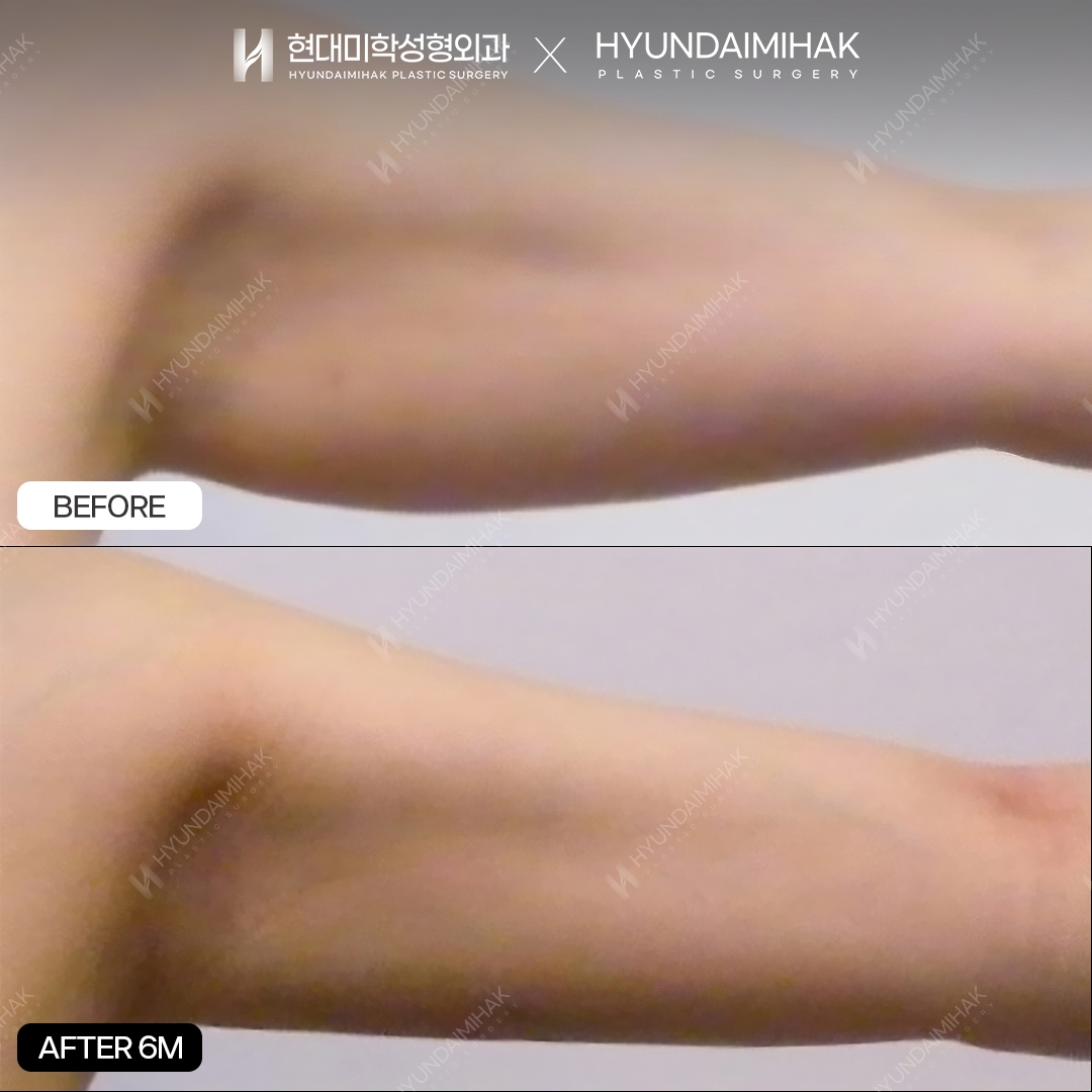 Upper-arm liposuction, 6 months after surgery