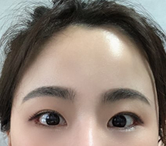 3 months after forehead lift