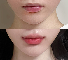 I Had Mouth-Corner Surgery