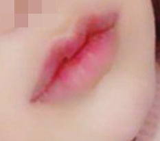 I highly recommend Hyundai Aesthetic Surgery mouth-corner + Cupid lip surgery