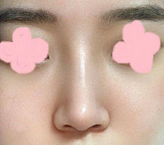Posting my 1-month photos after nose surgery!!haha