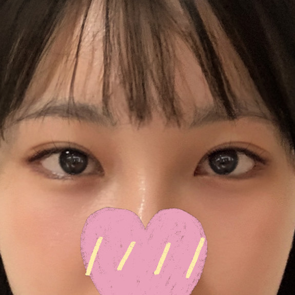 Review of canthoplasty and double-eyelid revision for small, narrow eyes