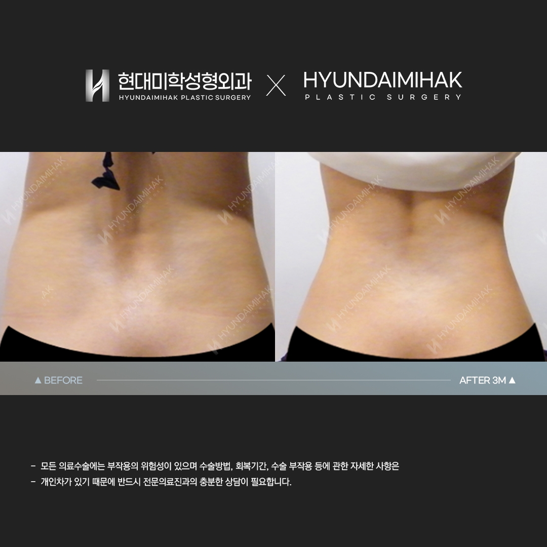Abdominal Liposuction, 3 Months