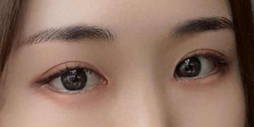 #Eye revision surgery #Incisional double-eyelid revision #Dual canthoplasty #Ptosis correction
