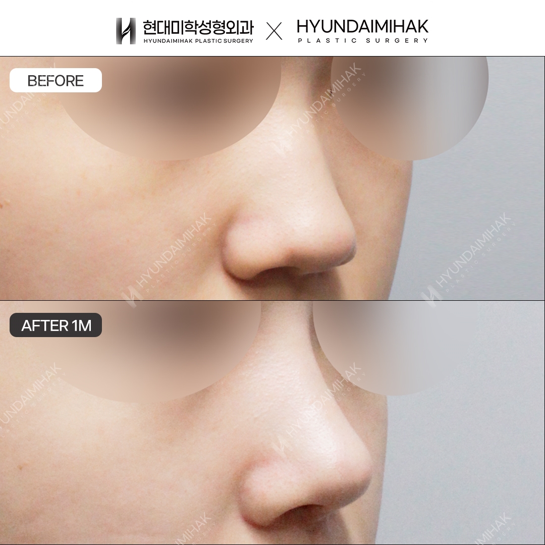 [Low Nose Surgery] Bridge + Tip, 1 Month