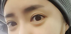 Incisional Double Eyelids