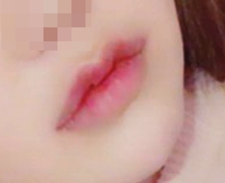 Lip surgery is amazing~~