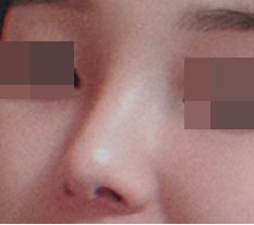 Rhinoplasty