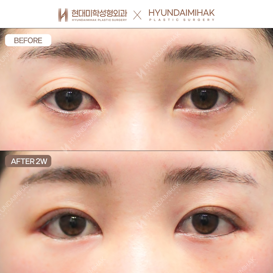 [Asymmetrical eye correction] Incisional double eyelid surgery + eye shape correction + dual canthoplasty