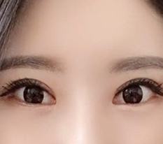 Hyundai Aesthetic Surgery is great for ptosis correction