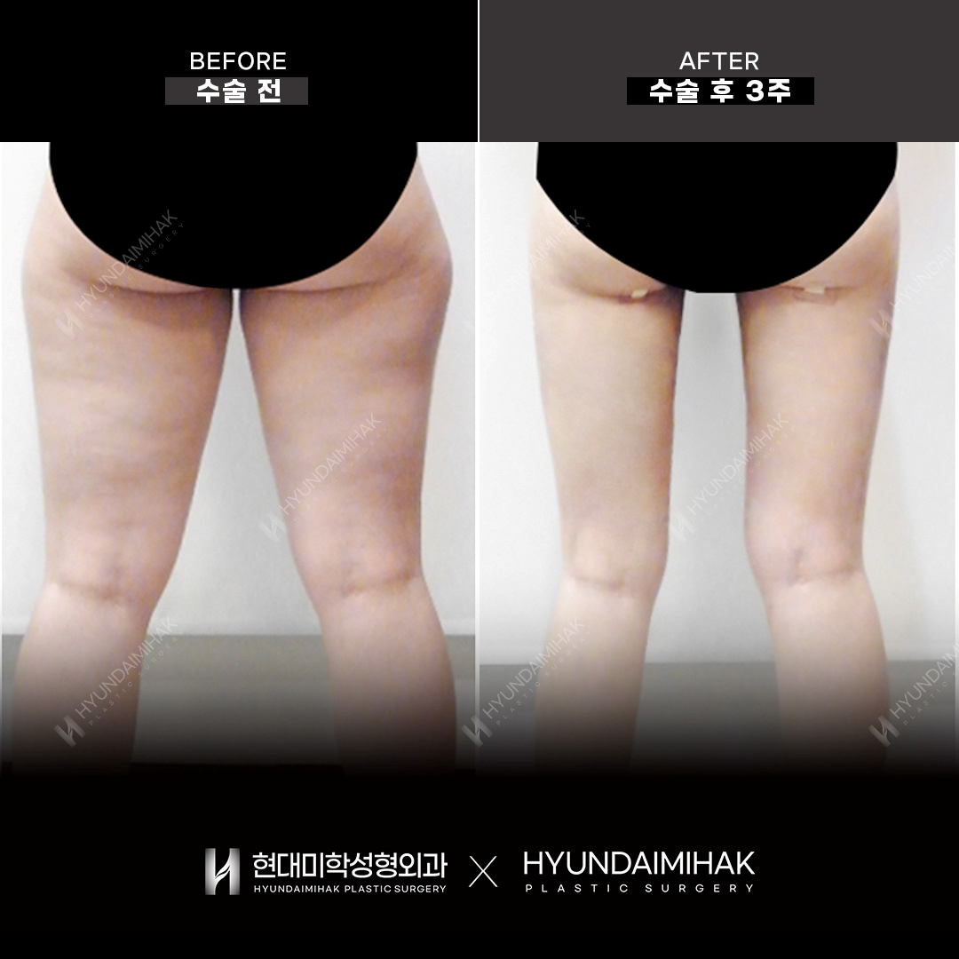 Thigh Liposuction, 3 Weeks