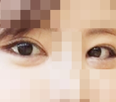 I got revision eye surgery and full canthoplasty!!